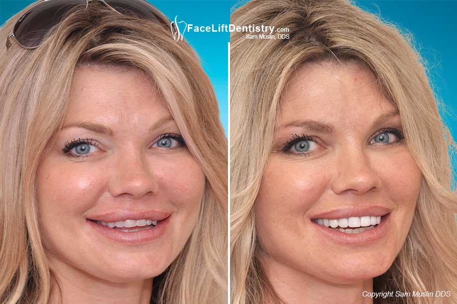 Before and After VENLAY Technology  Bite Correction