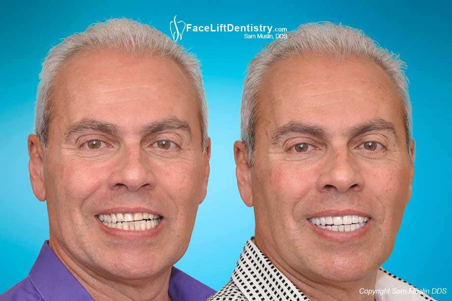 Worn Tooth Treatment - Before and After Photo