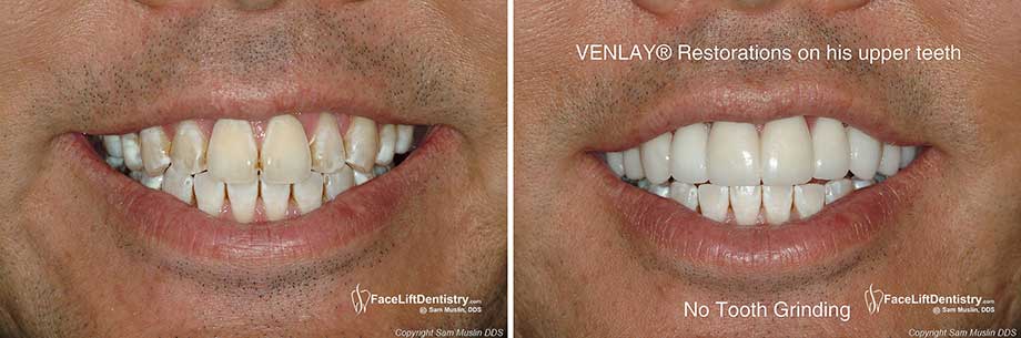 Closeup picture of weak, stained, worn tooth enamel and closup photo showing VENLAY Restorations on the top teeth after treatment