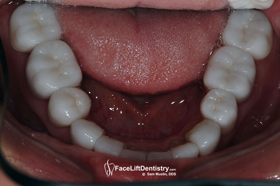 Bottom teeth with VENLAY<sup>®</sup> Restorations which require no grinding down.