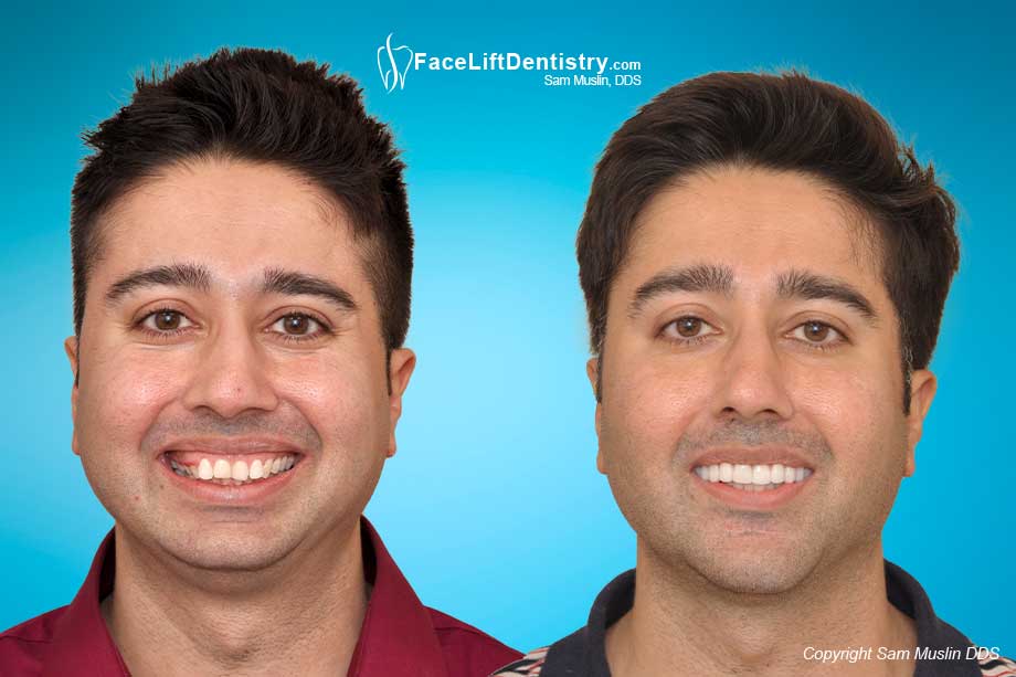 Symmetry, aesthetics, bite position optimized - before and after treatment