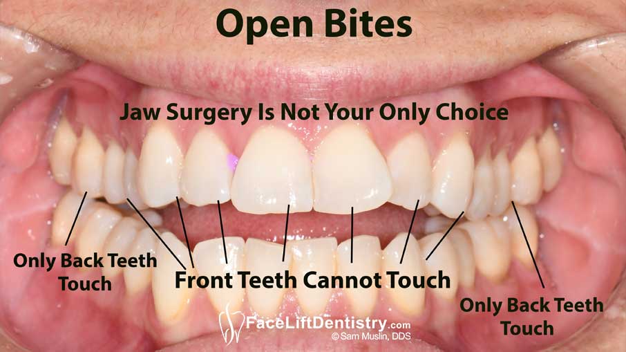 photo of an open bite, annotated