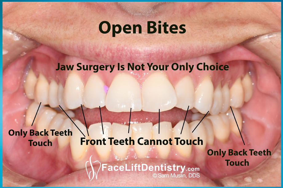 Fixing An Open Bite Without Surgery Or Braces Fixing An Open Bite Without Surgery Or Braces