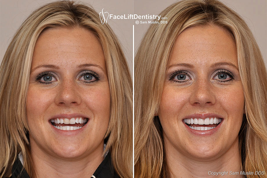 Wider Smiles with NoDrilling Veneers