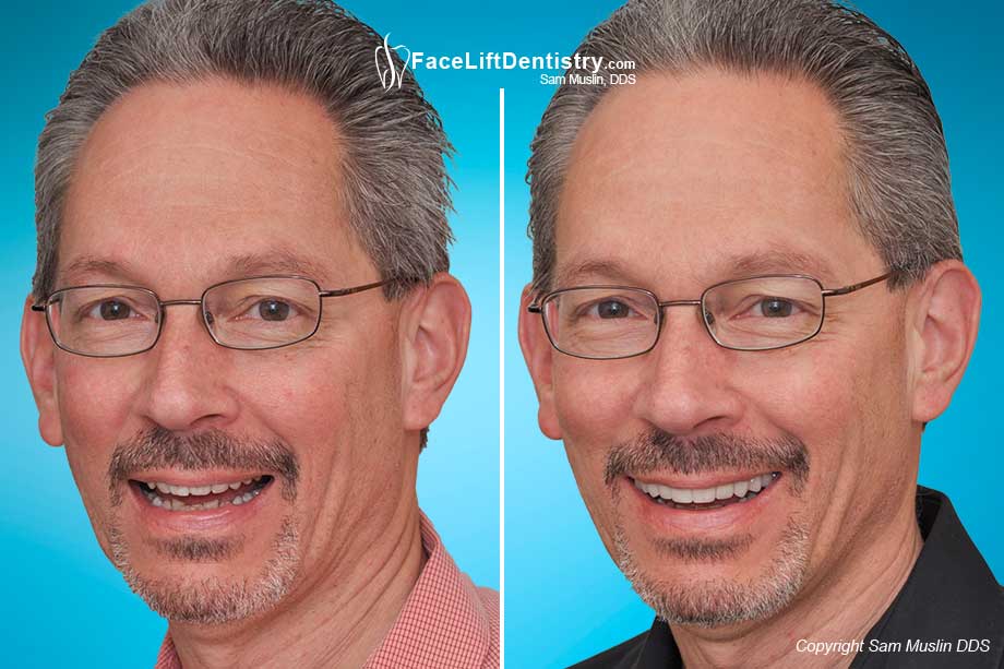 A Wider Smile - Before and After