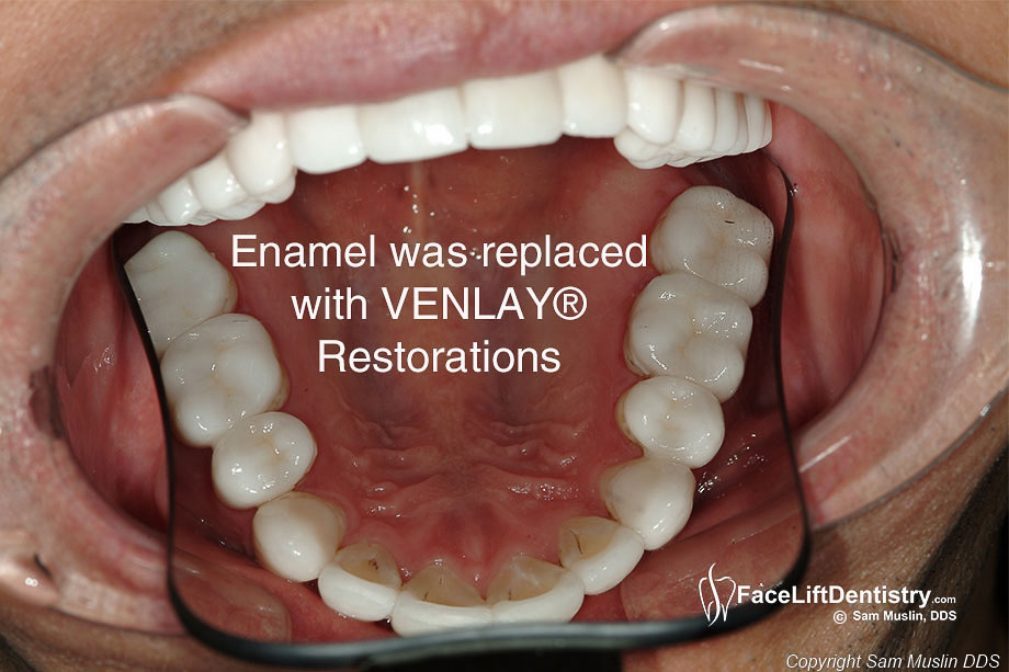 Replacing Tooth Enamel