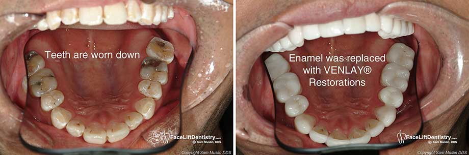 Closeup showing before and after Tooth Enamel Replaced and the  Bite Corrected