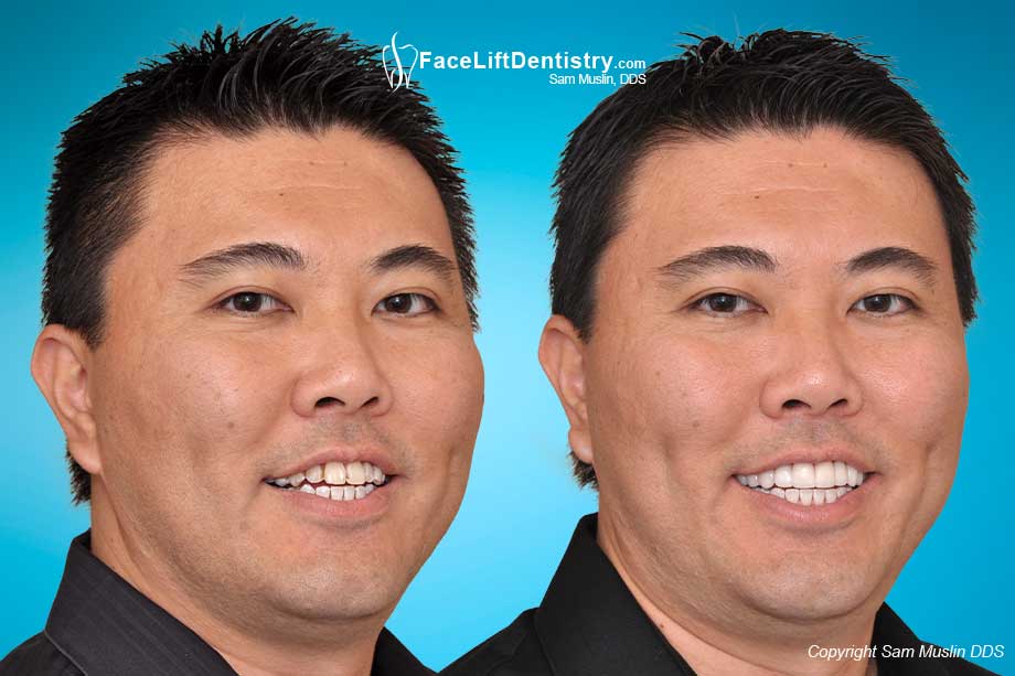 Before and After Picture showing  Enamel Replacement and Bite Correction on Worn Teeth