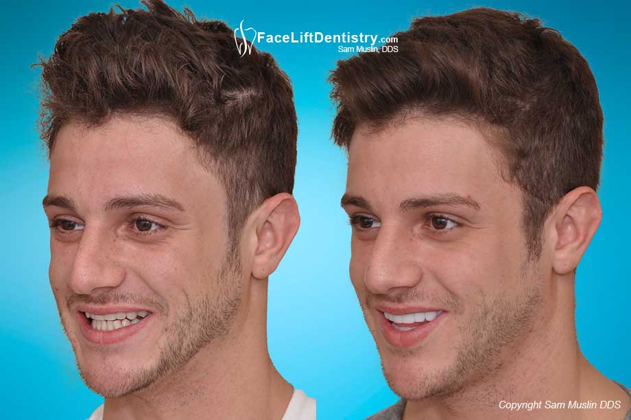 The aging mouth - even at a young age. Before and After Treatment.
