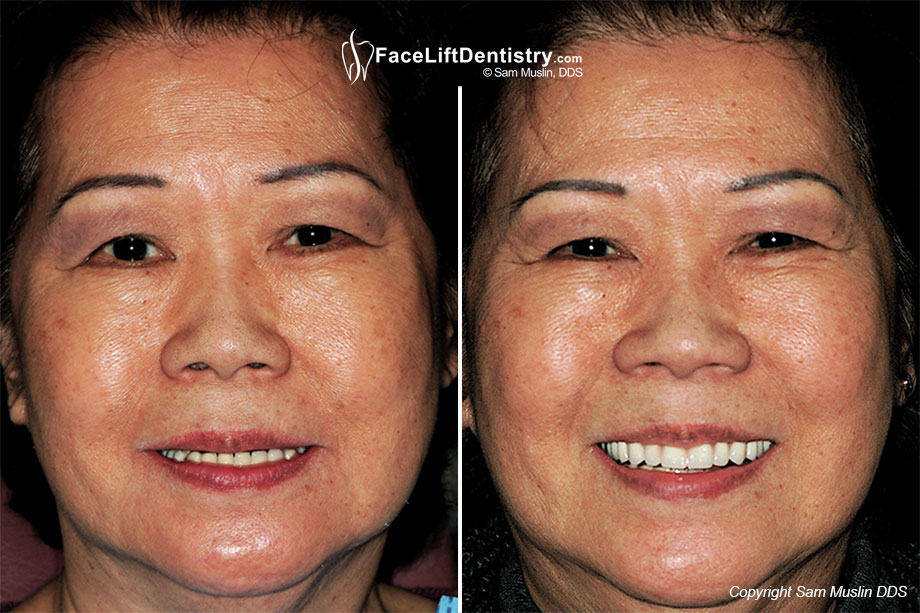 Can't See My Upper Teeth Anymore! - Before and After Photo