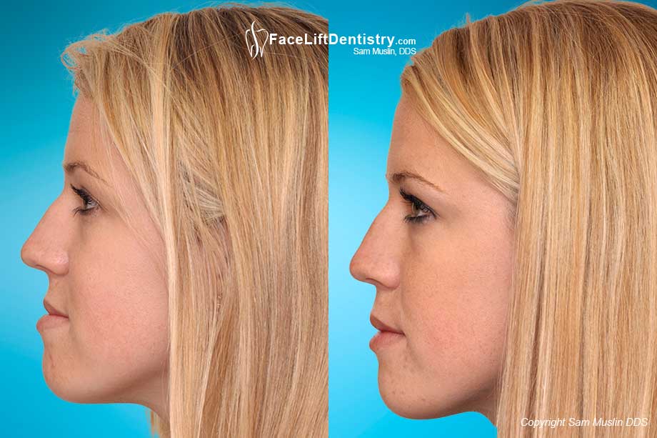 Under Bite Correction without Surgery or Braces Under Bite Correction without Surgery or Braces