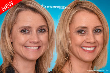 Pseudo-Class III Malocclusion with Crossbite Fixed in 8-Days - Before and After Photo