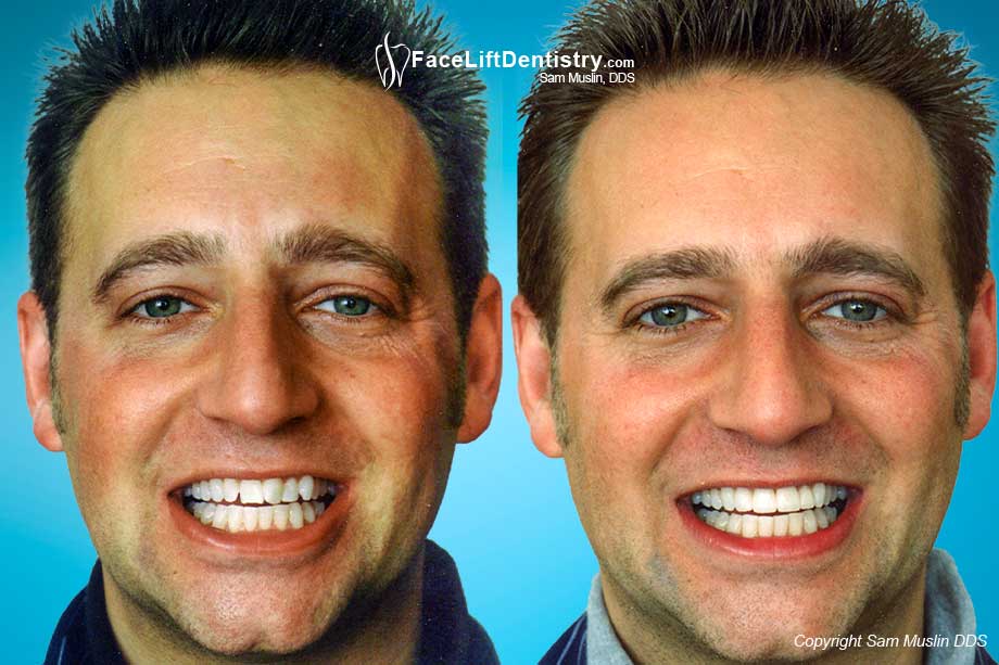 Crooked Teeth Porcelain Veneers - Before and After Photo