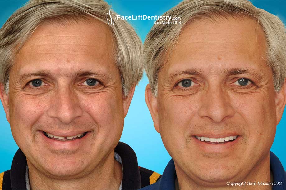 Aging Face, Small Chin.