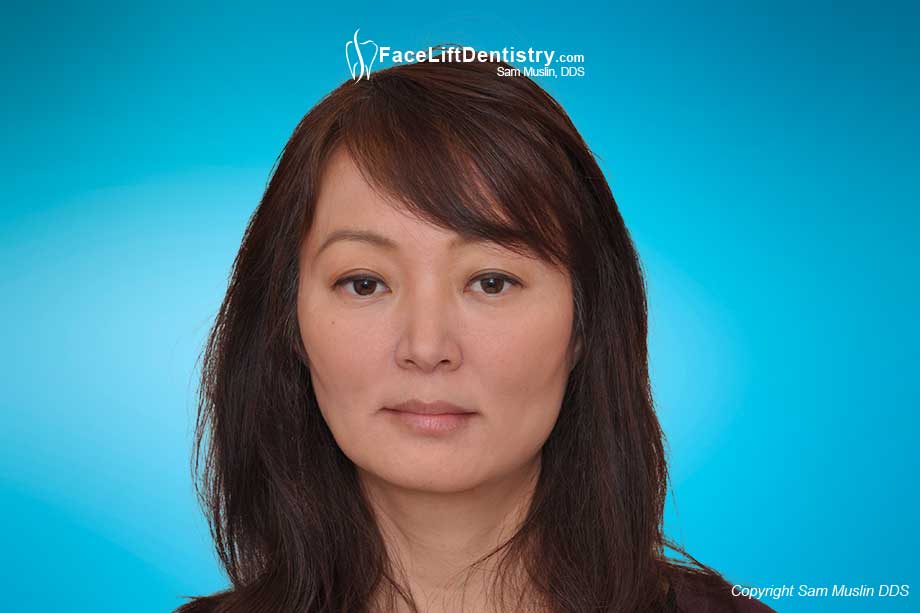 Cosmetic Dentistry Gone Bad - Before and After Photo