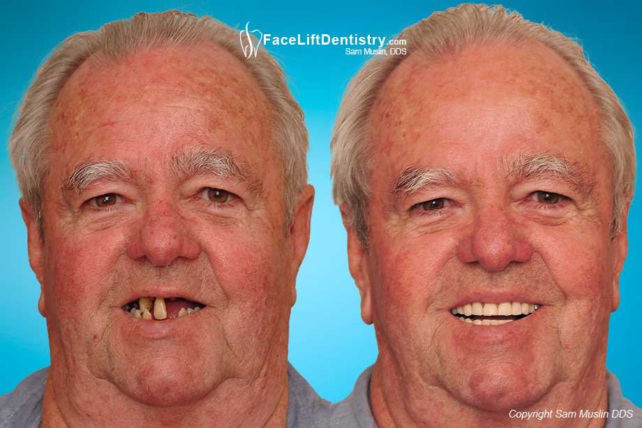 Bad Bite, Bad Dentistry and Bad Crowns - Before and After Photo