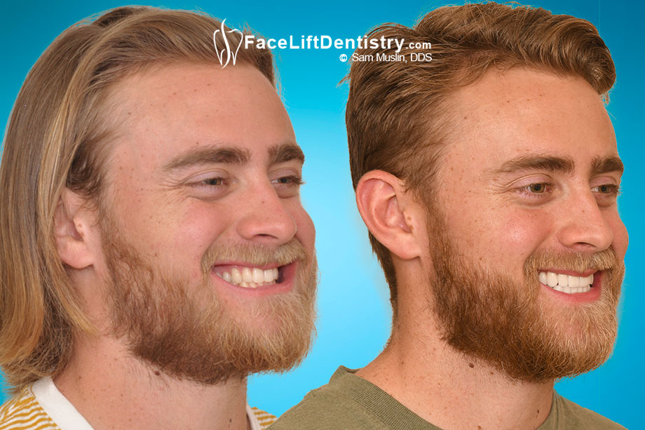 Clicking and Lockjaw Problems - Before and After Photo