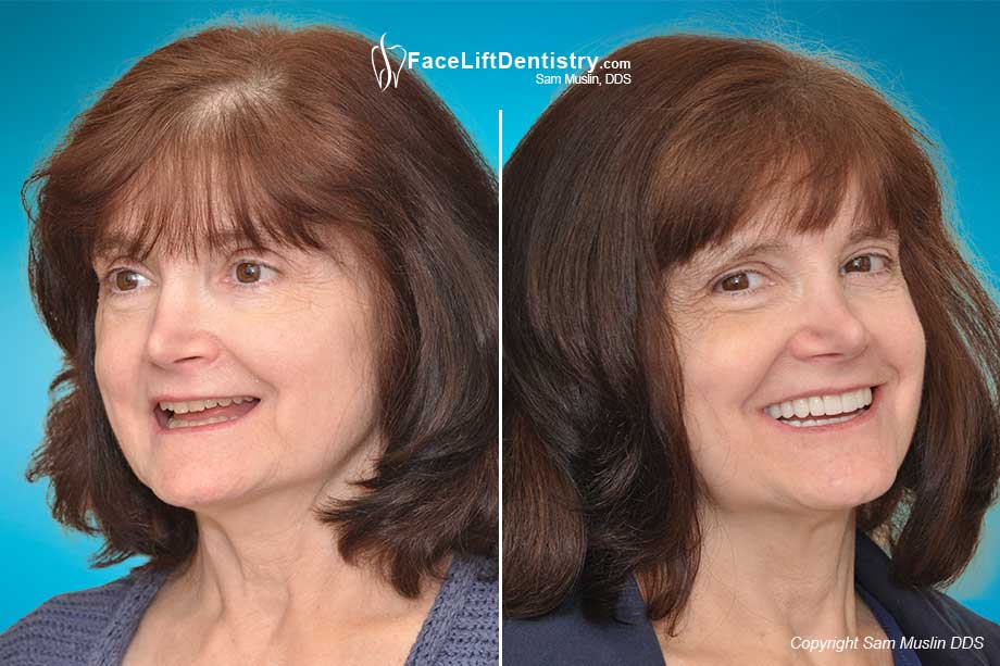 Facial Collapse Reversed with Non-Invasive Anti-Aging Dentistry - Before and After Photo
