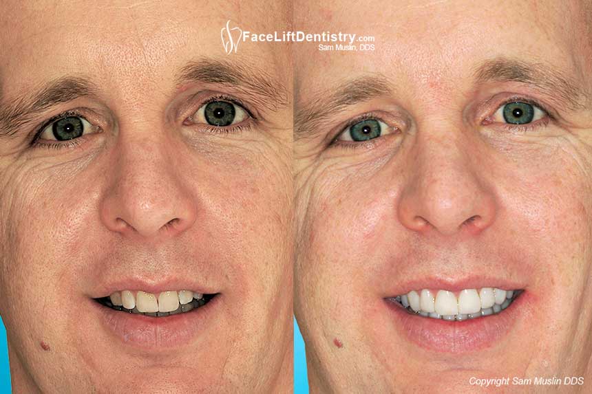 VIP Cosmetic Dentistry for Executives - Before and After Photo