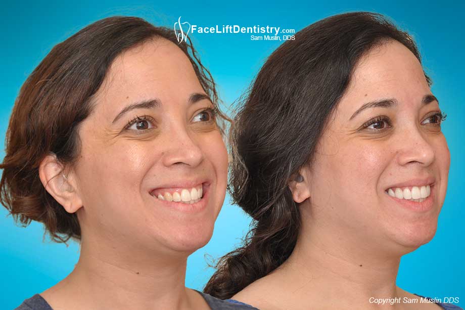 Speech Clarity and the Optimal Jaw Position - Before and After Photo