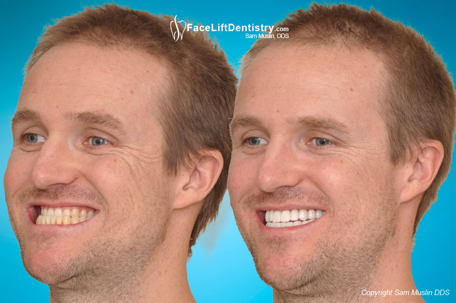 Underbite Quick Fix - Before and After Photo