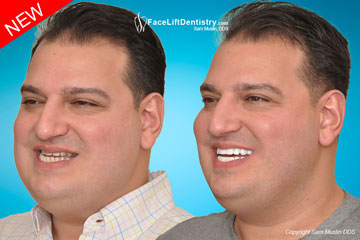 Underbite Crooked Jaw Surgery Avoided - Before and After Photo