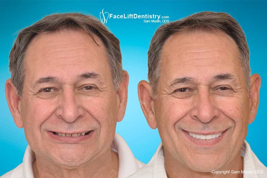 teeth buck correction bite uneven braces fixing surgery open treatment protruding without veneers corrected