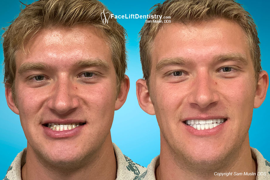 Underbite Prognatism - Before and After Photo