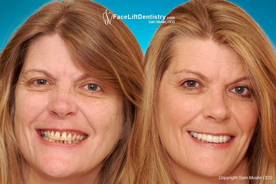 Receding Gums Treatment - Before and After Photo