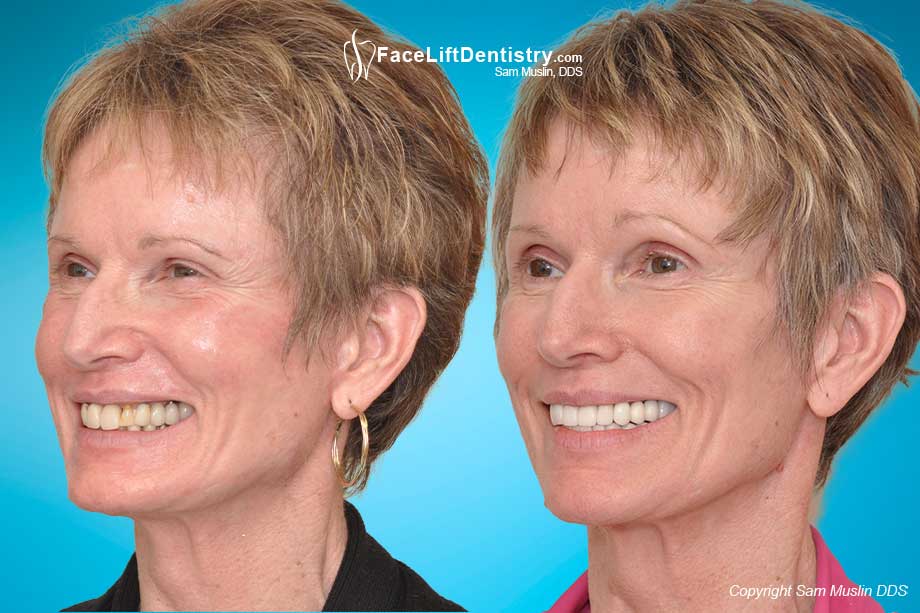 a patient showing a younger face and better health before and after anti-aging facelift dentistry