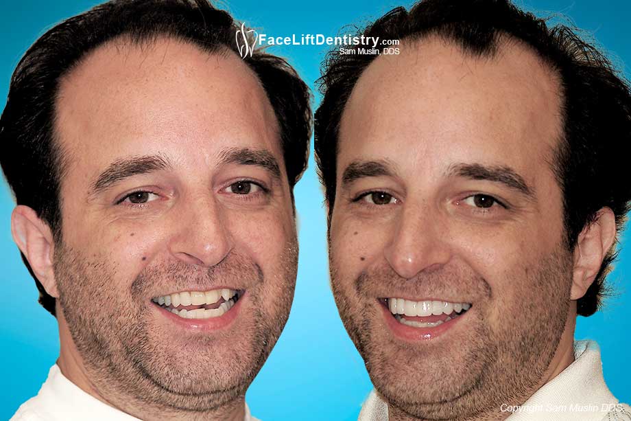 Crooked Teeth and Instant Braces - Before and After Photo