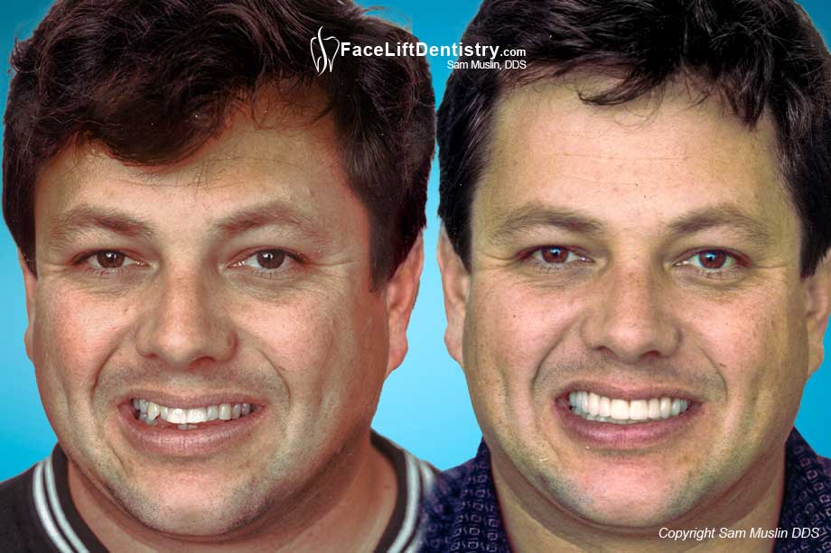 Bad Bite, Crooked Teeth, Bad Crowns Tooth Grinding - Before and After Photo