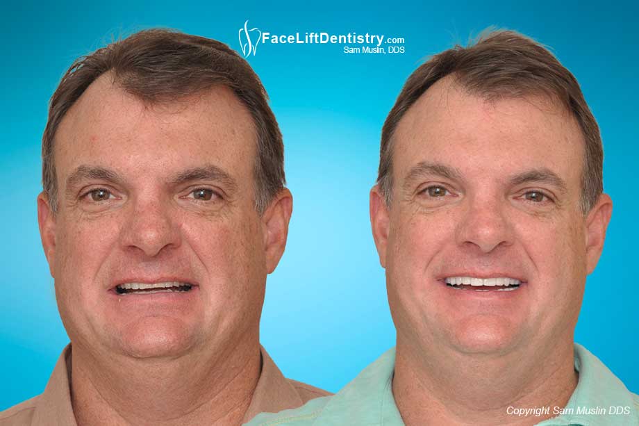 Overbite Fixed No Downtime - Before and After Photo