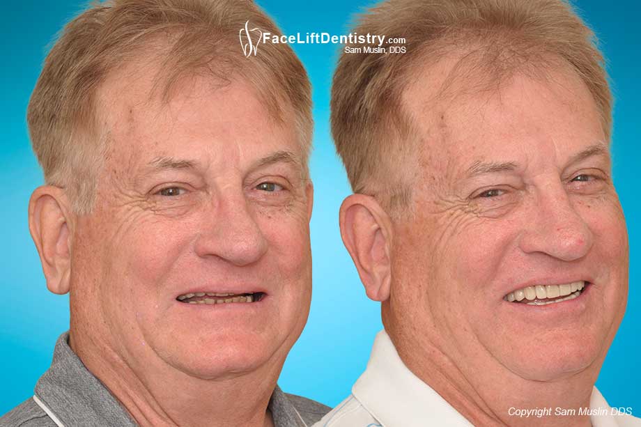 Restoring Aging Teeth with VENLAY® Restorations - Before and After Photo