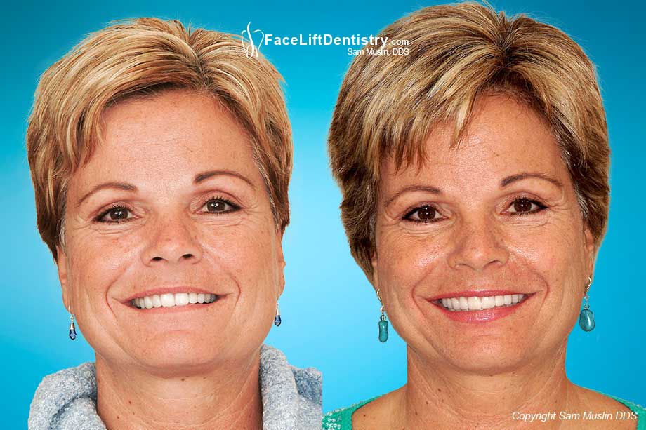 Deep Overbite Correction - Before and After Photo