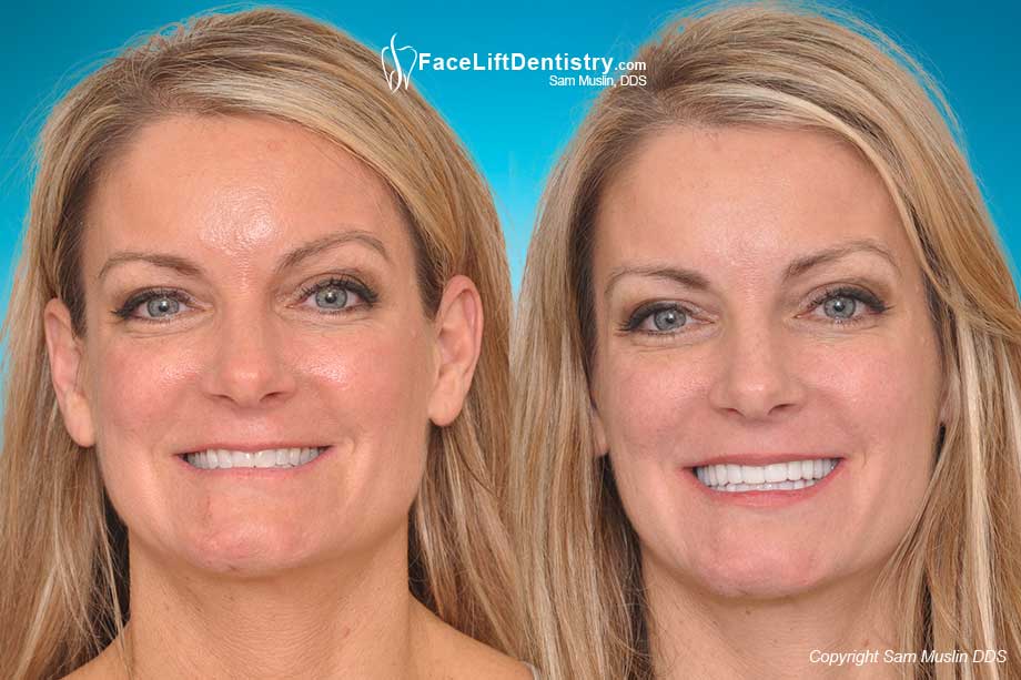 Anti-Aging Dentistry with VENLAY® Restorations
