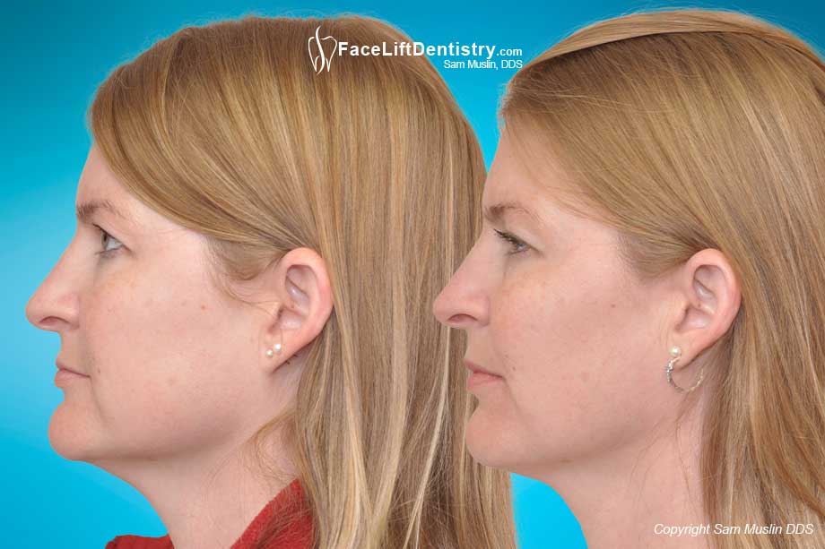 Small Teeth and Posterior Bite Collapse - Before and After Photo