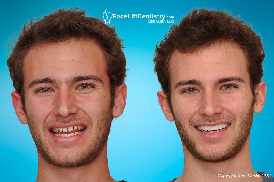 Gaps Between His Teeth - Instant Braces - Before and After Photo