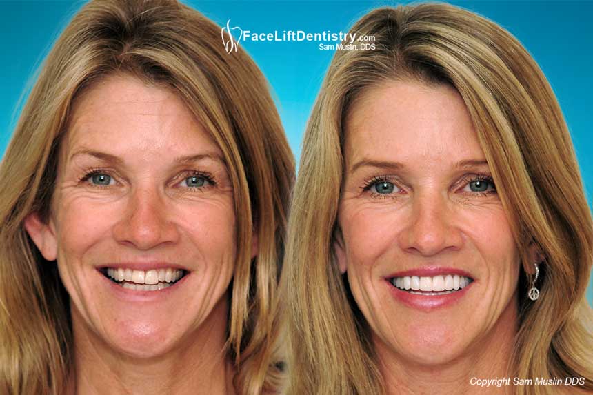 Porcelain Veneers and Cosmetic Dentistry - Before and After Photo