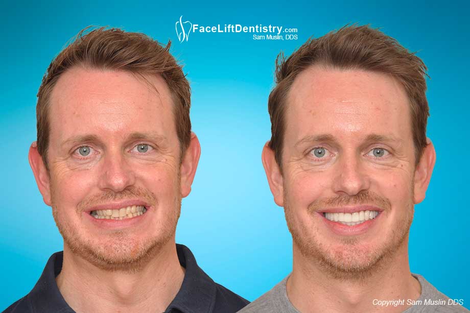 Overbite and Crooked Jaw - Before and After Photo
