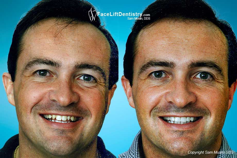No Tooth Grinding Porcelain Veneers - Before and After Photo