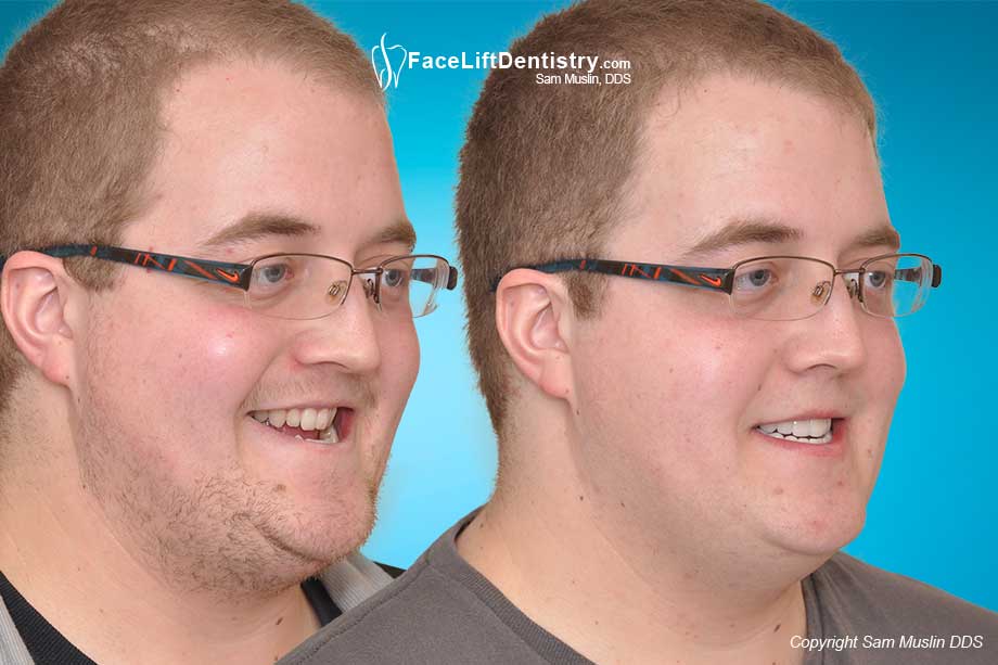 Before and After Photos: Underbite, Overbite, Open Bite