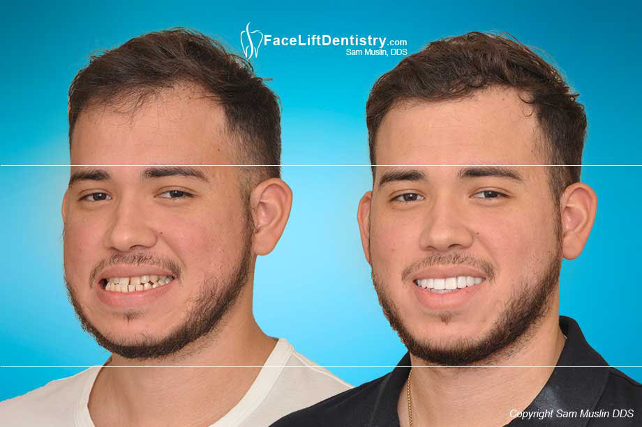 underbite dentistry overbite muslin