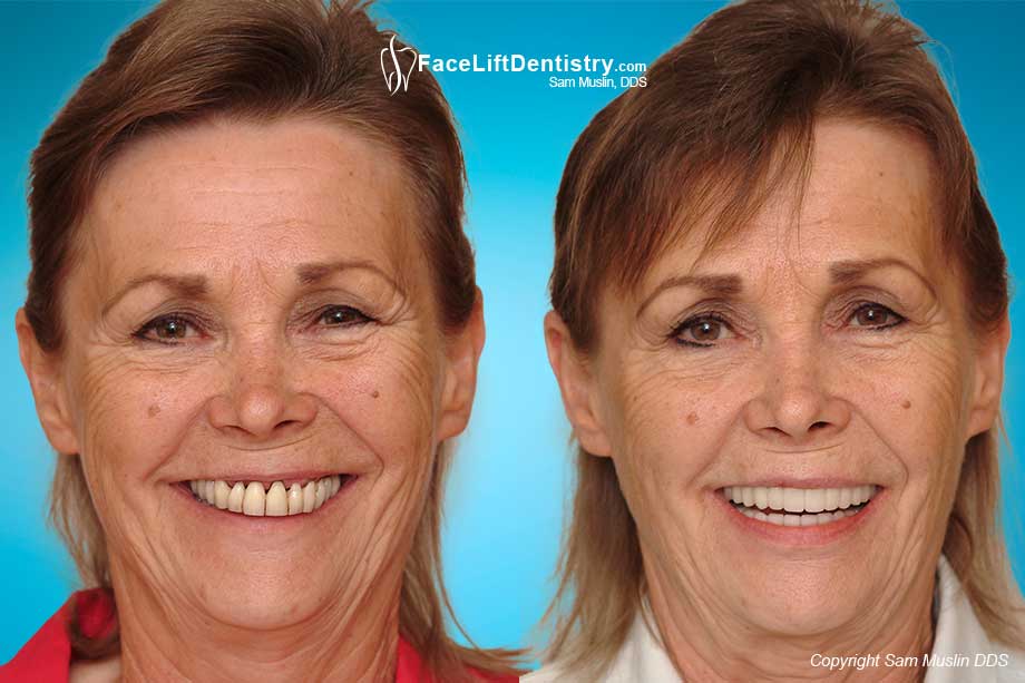 Treating Gum Recession and Gum Loss - Before and After Photo