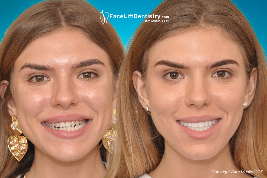 Facelift Dentistry Before And After Photos