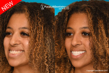 Underbite JawTrac Jaw Position - Before and After Photo