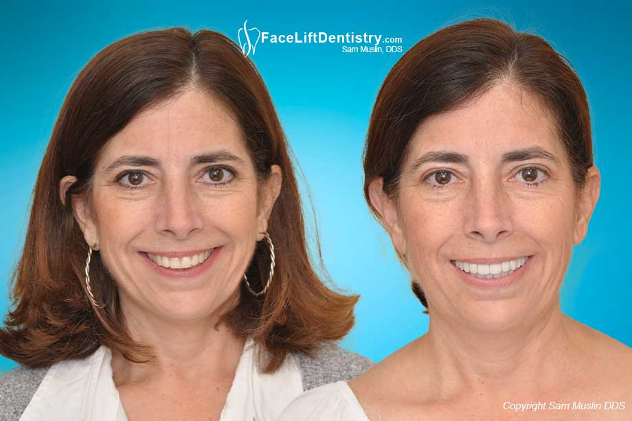 Jaw Stress and Neck Pain - Before and After Photo