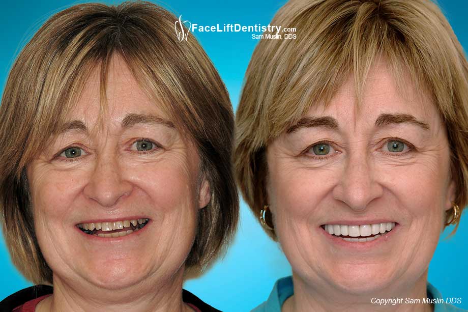 Older Lady Round face - Anti-Aging Dentistry - Before and After Photo
