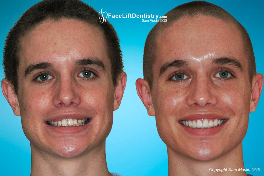 Before and After Photos Bite Correction without Surgery or Braces
