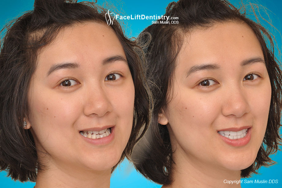 What Happens If You Have No Back Teeth? - Before and After Photo